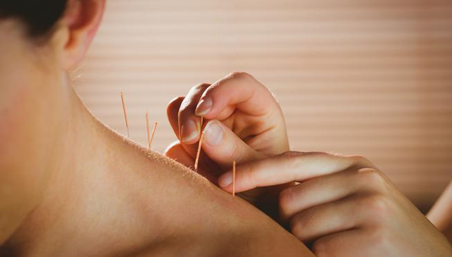 Acupuncture and Sports Massage - Elevate Physiotherapy in Yeovil, Somerset